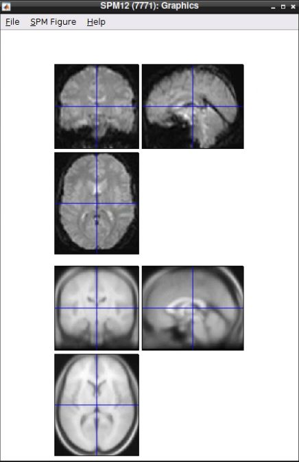 Normalized functional image and canonical anatomical template