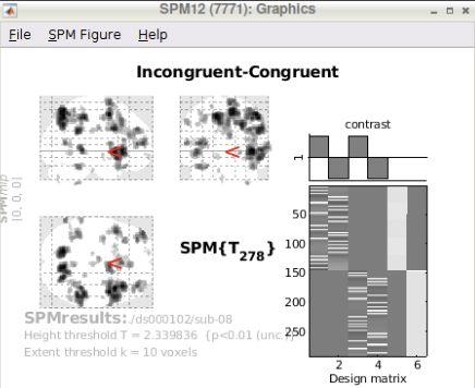 SPM result for Incongruent-Congruent at uncorrected p 0.01 and extent 10